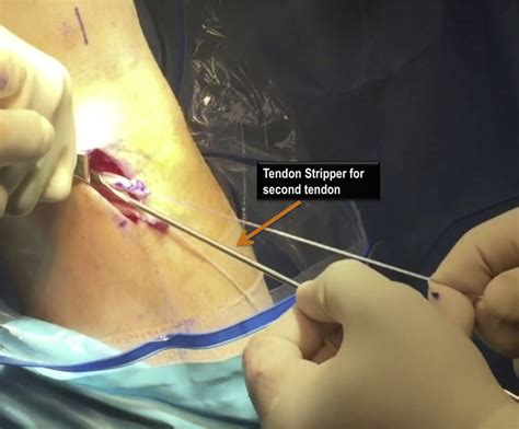 The symptoms of tendinopathy include pain, swelling and reduced function. Intraoperative photograph (left leg) showing the use of the tendon... | Download Scientific Diagram