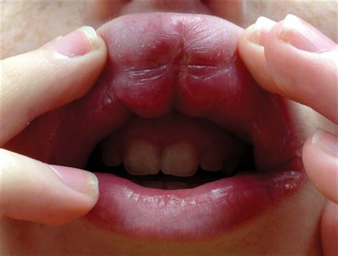 Swollen Upper Lip Causes Symptoms Sudden And Top Lip Swelling