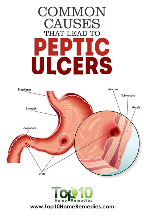 Learn what causes duodenal ulcers and how best to deal with them. Here's everything that you must know about peptic ulcer ...
