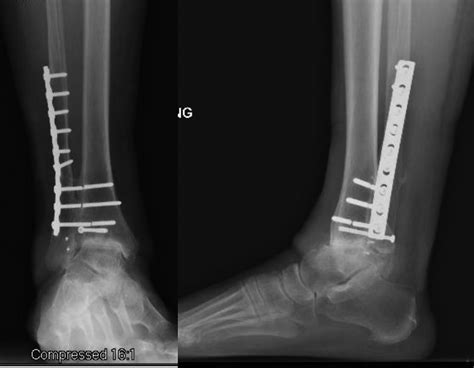 Ankle Arthrodesis Using An Anterior Titanium Dual Locked Plating