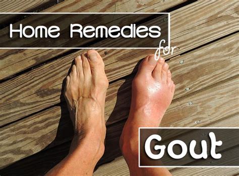 Top 12 Home Remedies For Gout Starsricha