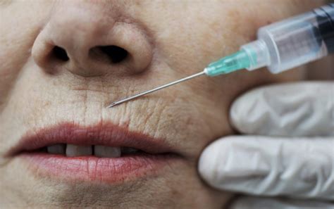Botox For Smokers Lines Before And After Cosmetic Surgery Tips