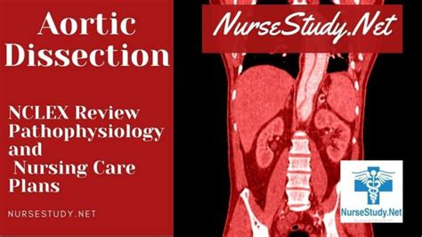 Aortic Dissection Nursestudy Net