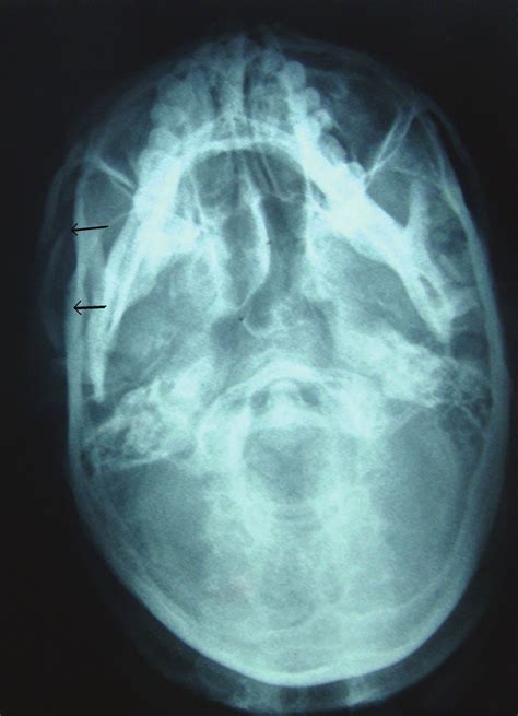 Preoperative Radiograph Submentovertex View Showing The Right