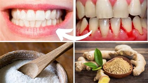 How To Get Rid Of Gum Pain How To Get Rid Of Gum Problems At Home No