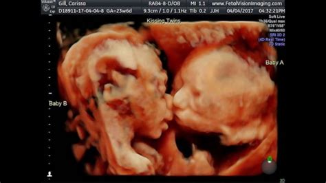 video sonogram shows twin sisters kissing inside mother s womb abc news