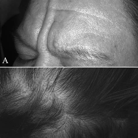 A Cutis Verticis Gyrata The Hypertrophy And Folding Of The Skin Can