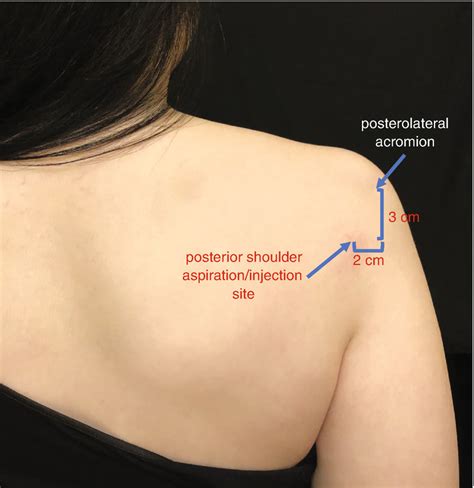 Techniques In Orthopedics Springerlink