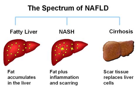 Alcoholic Fatty Liver Alcoholic Hepatosteatosis Digestive Diseases