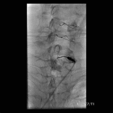 Cervical Interlaminar Epidural Steroid Injection Fluoroscopic Guided