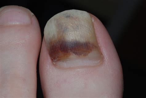 Subungual Haematoma Demonstration Of Haematoma By Clear Nail Growth