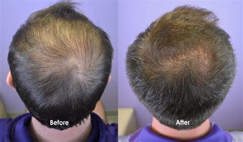 Low Dose Minoxidil Pill Prescribed For Early Hair Loss Hair