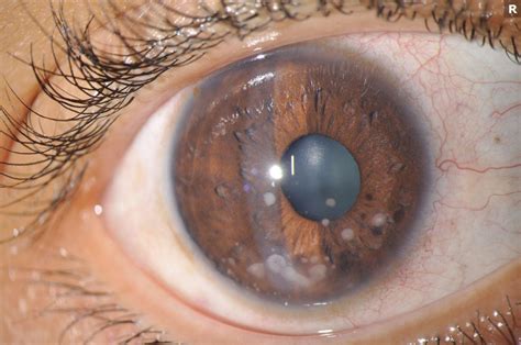 West Coast Retina Case Of The Month March 2022