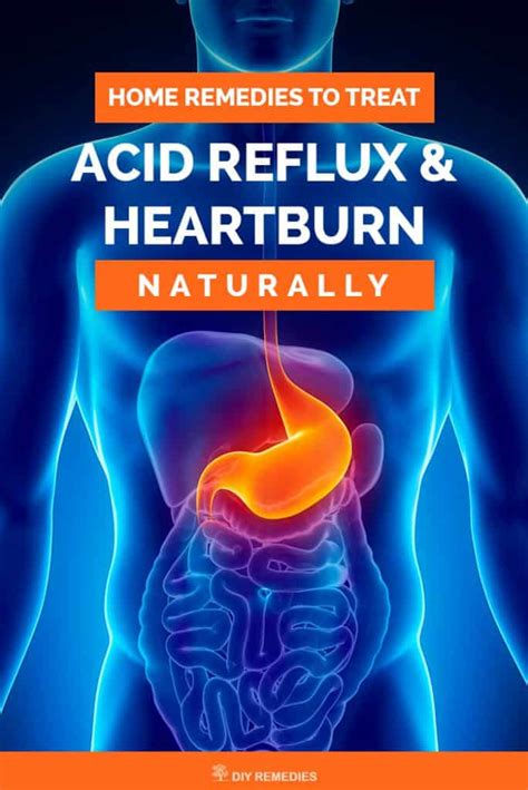 Home Remedies To Treat Acid Reflux And Heartburn Naturally