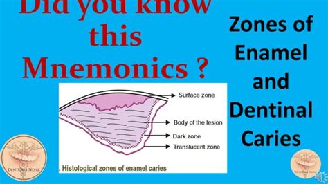 Mnemonics Histological Zones Of Enamel And Dentinal Caries Ppt