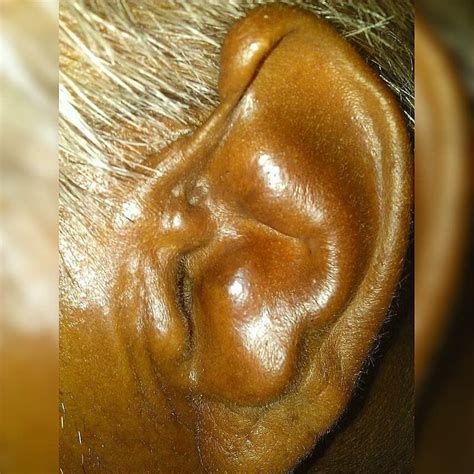Cauliflower Ear Is An Irreversible Condition That Occurs When The