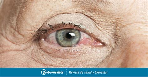 ojo seco causas síntomas y tratamiento
