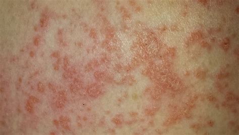 Lamictal Rash Causes Symptoms Pictures And Treatment