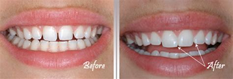 Nowadays there are also various ways to fix these dental gaps. How to fix a gap in my two front teeth - Quora