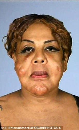 Transgender Woman Who Had Cement And Tire Sealant Injected Into Her Face To Try And Look More