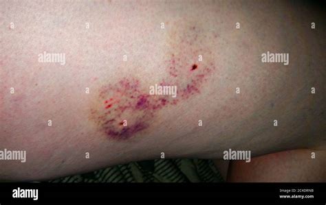 Puncture Wound Infection Hi Res Stock Photography And Images Alamy