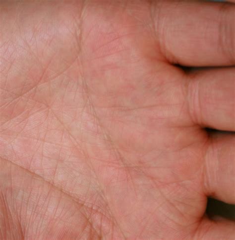 Mild Eczema On Hands Treatment Images And Pictures Becuo