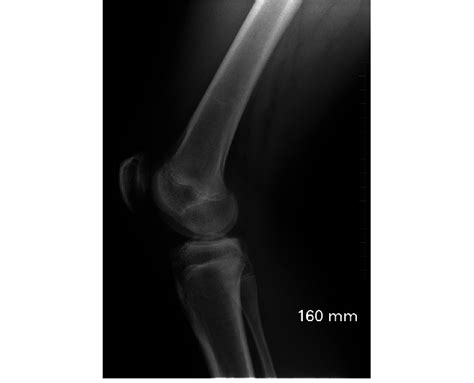 Lateral Radiograph Of The Operated Knee Showing No Sagittal Deviation
