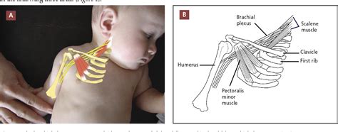 Shoulder Dystocia Brachial Plexus Injury