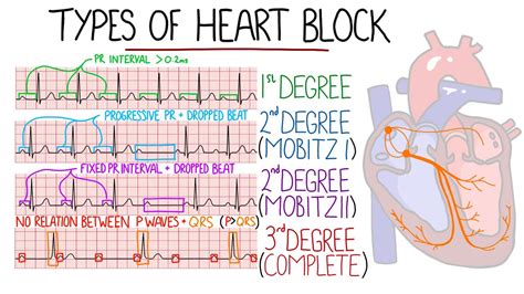Heart Blocks Made Easy St Nd Mobitz Wenckebach Mobitz Rd Complete With ECGs