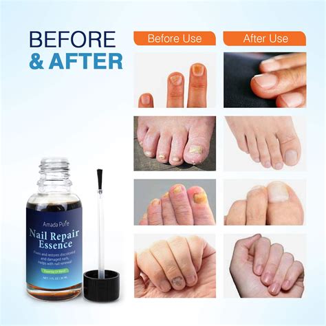 Toenail Fungus Treatment Nail Fungus Treatment Fungus Stop Fingernail Fungus Fungi Nail