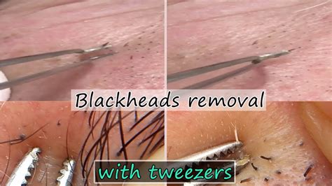 Blackheads Removal Under Nose With Tweezers Youtube