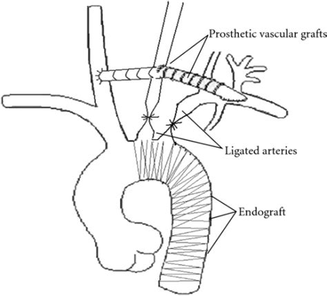 Illustration Of The Surgical Technique The Carotid To Open I