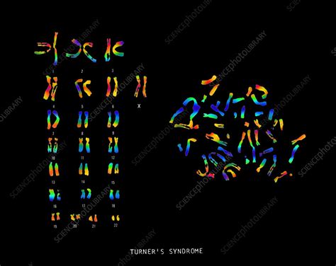 Turner S Syndrome Karyotype Stock Image C Science Photo