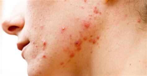 Cystic Acne Symptoms Causes And 20 Natural Treatments