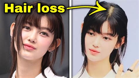 Fans Concerned For Newjeans Danielle Hair Loss Kpop Youtube