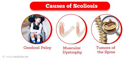 Scoliosis Facts Causes Types Symptoms And Treatment