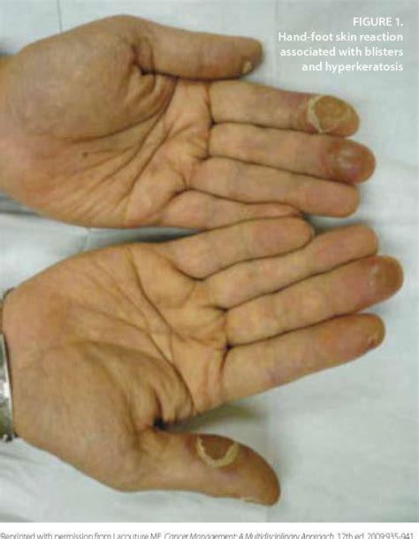 Figure 1 From Prevention And Management Of Hand Foot Syndromes