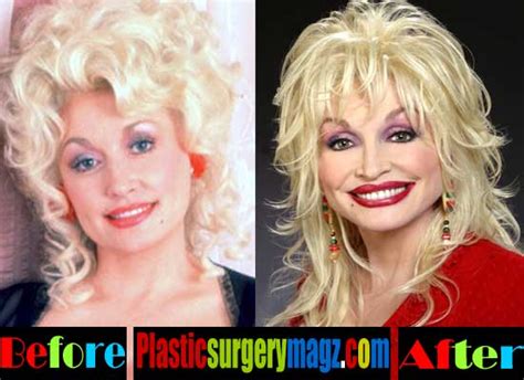 Dolly Parton Plastic Surgery Before And After Pictures Plastic