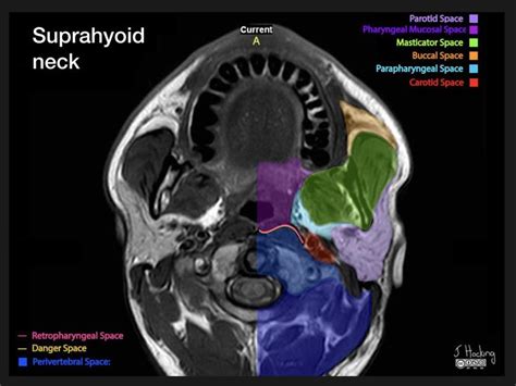 Suprahyoid Neck Skull Anatomy Anatomy Radiology