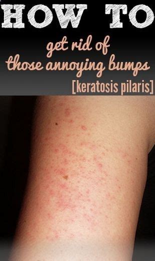 Bumps On The Back Of Arms With Images Health And Beauty Tips Skin