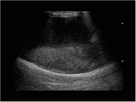 Groin Hematoma Ultrasound