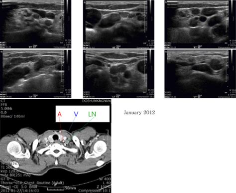 Thyroid And Neck Sonography Enlargement Of Multiple Lymph Nodes