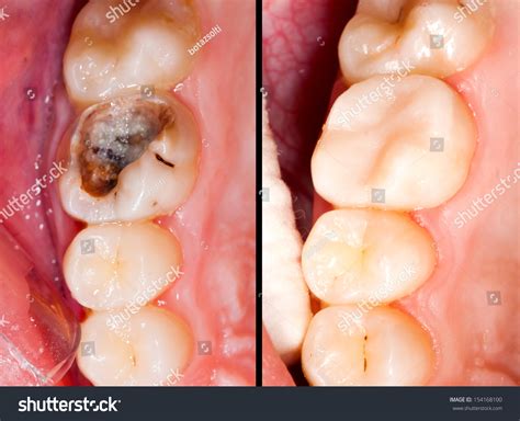Decayed Tooth Before After Restorative Treatment Stock Photo Edit Now