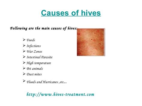 Hives Treatment