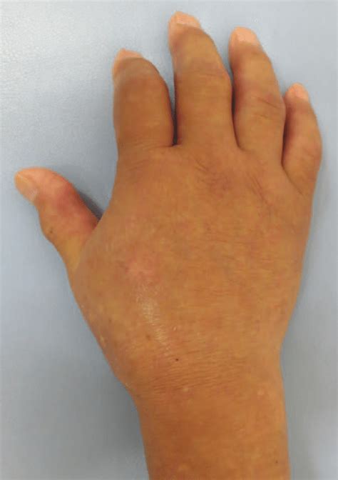 Photograph Of The Right Hand At The Initial Visit The Patients Right
