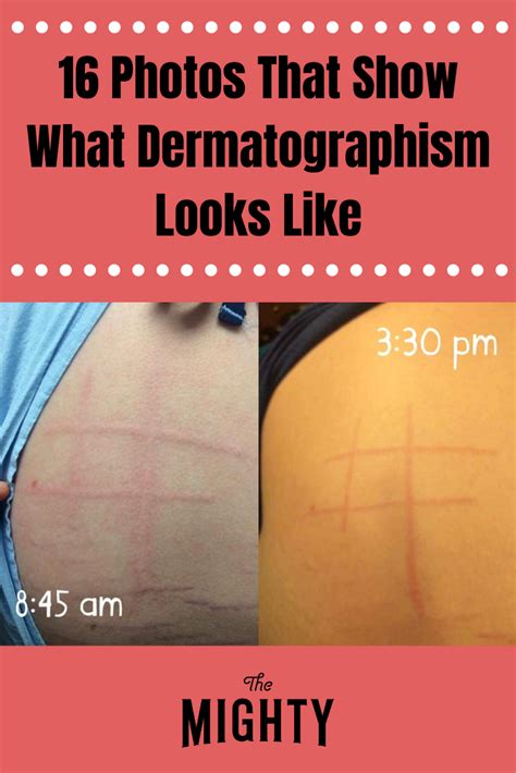 16 Photos That Show What Dermatographism Looks Like Chronic Illness