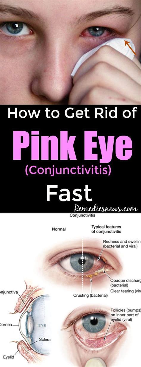 How To Get Rid Of Pink Eye Conjunctivitis Fast Pink Eyes Pink Eye Home Remedies Bacterial