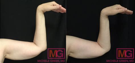 Non Surgical Arm Lifts Armpit Fat Fat Removal For Arms