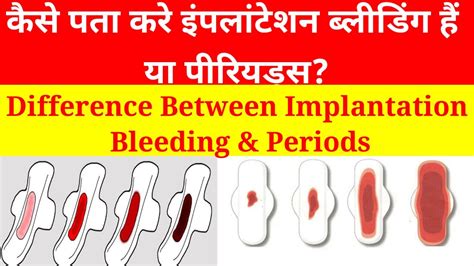 Iimplantation Bleeding Vs Period And Implantation Bleeding In