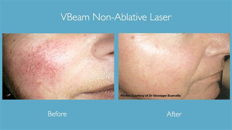 Vbeam Laser Treatment For Non Ablative Skin Rejuvenation Dermatology